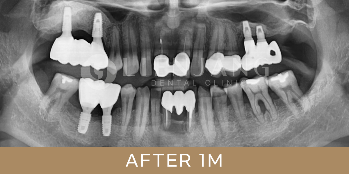 dental work in korea - implant