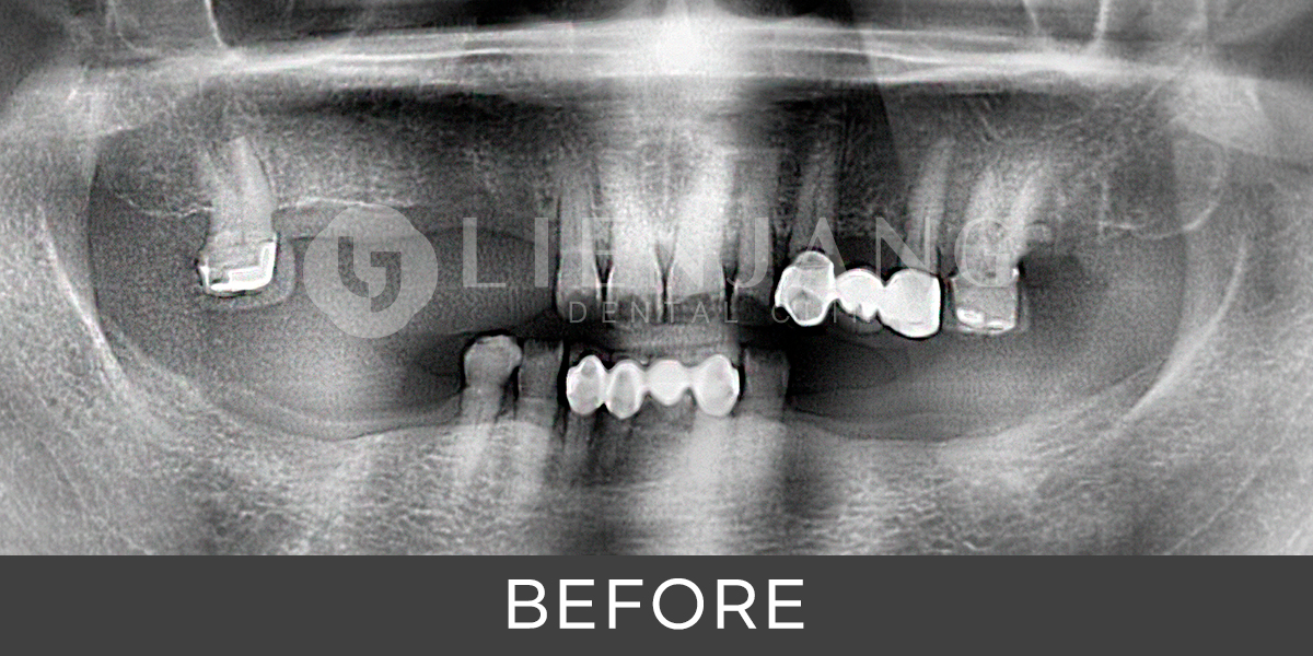 dental work in korea - implant