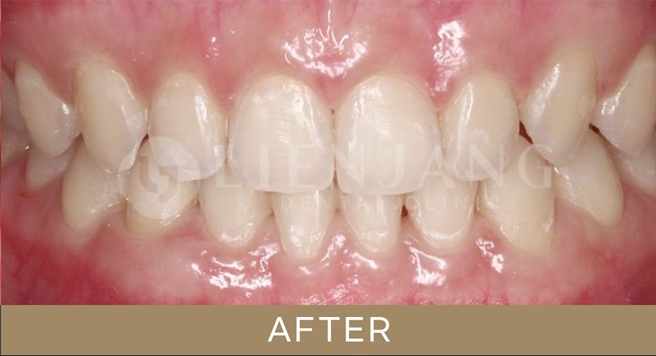 alignment pricing in korea - invisalign