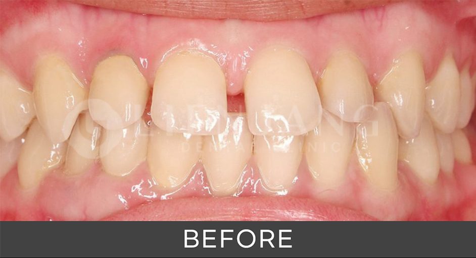 alignment pricing in korea - invisalign