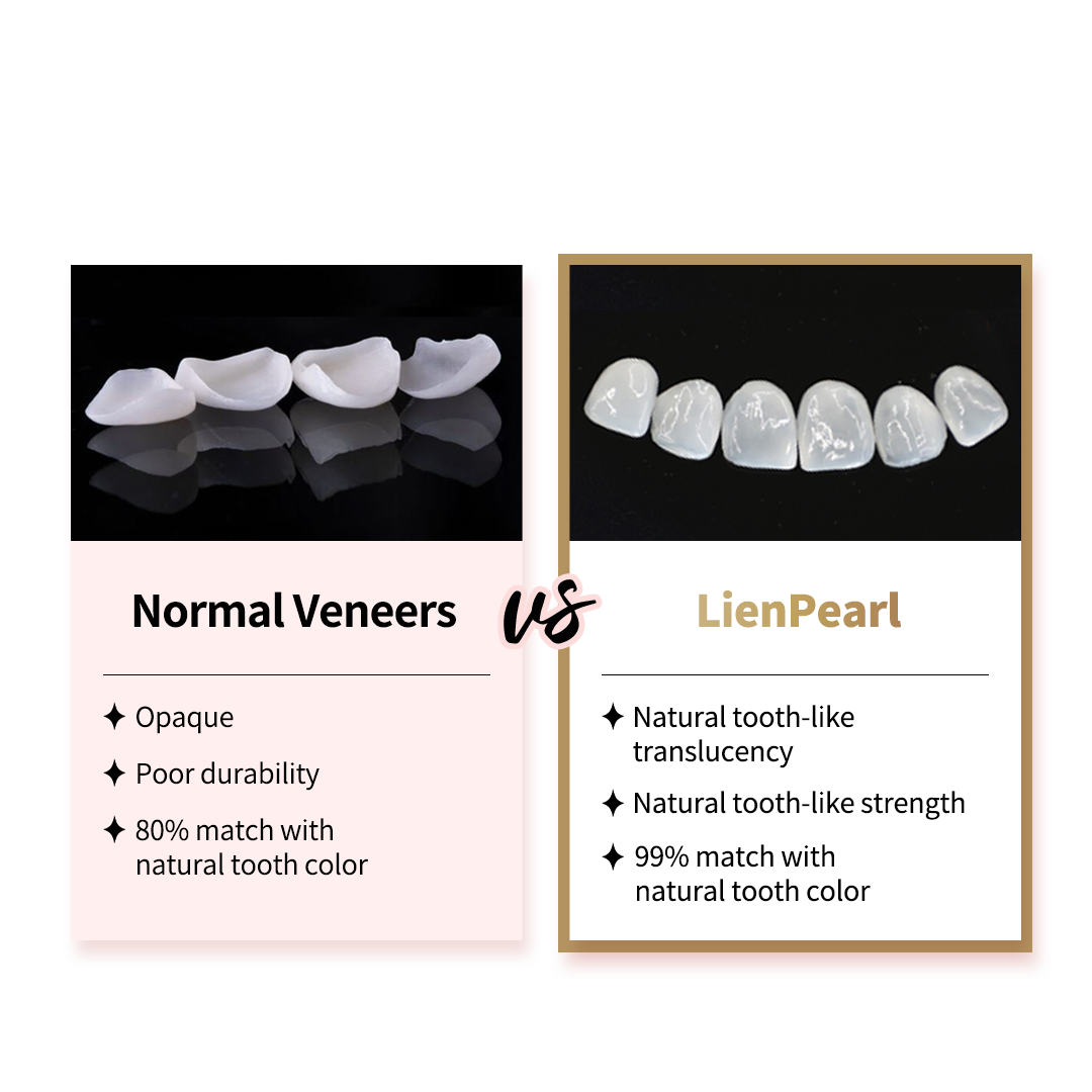 veneers in korea