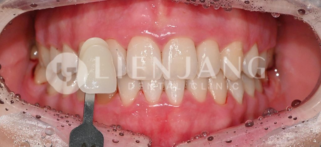 teeth whitening in korea