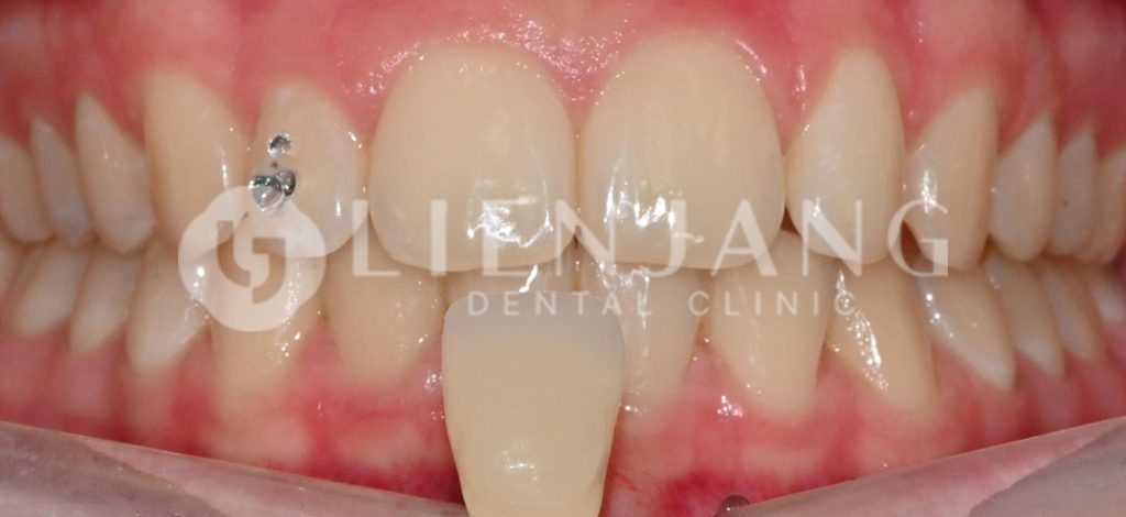 teeth whitening in seoul
