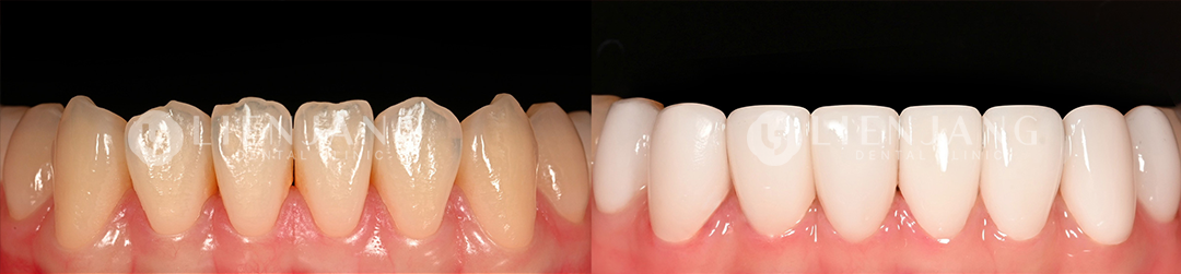 veneers in gangnam
