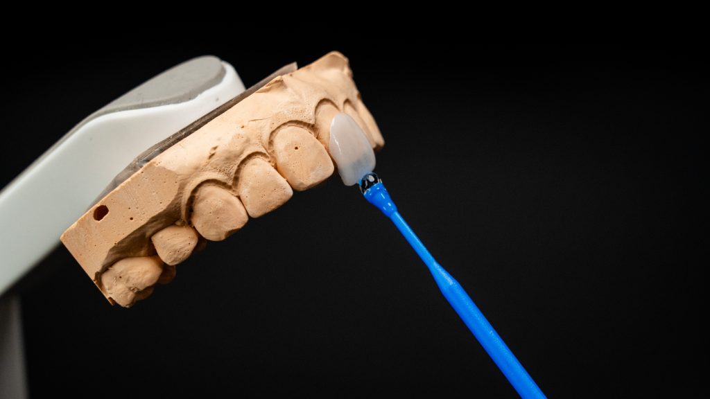 Veneers in korea