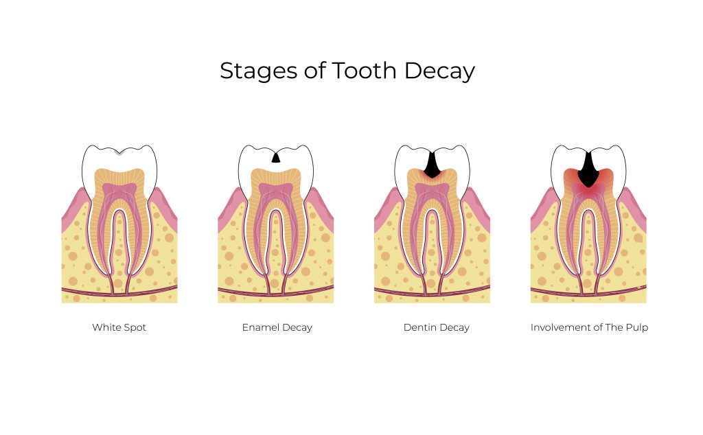 cavity treatment in korea